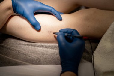 Phlebologist damara enjeksiyon yapar, kadın bacağının damarlarında skleroterapi uygular, yakın plan. Varisli damarların tıbbi tedavi konsepti