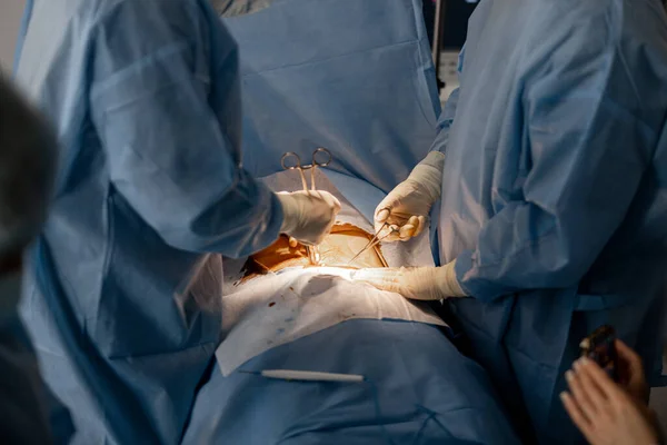 Kaksi Kirurgia Leikkaa Potilaan Vatsan Aluetta Todellisen Toiminnan Kirurgisen Toimenpiteen kuvapankkikuva