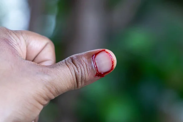 cut wound at the thumb with Blood on the finger of the hand and blurred background