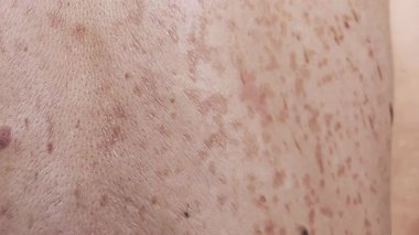 Yüzeysel mantar derisi enfeksiyonu, pigmentli lekeler ve tinea versicolor 'un sebep olduğu renk bozulması olan insan sırtına yakın çekim. Görünürde yüz yok. Gerçek deri dokusu.