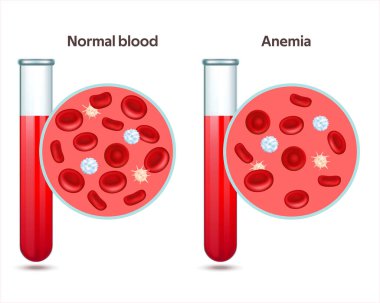Two test tubes with normal blood and specimen with anemia disease.  Thrombocytes, leukocytes and erythrocytes under microscope. Microbiology test. Vector illustration EPS 10 clipart