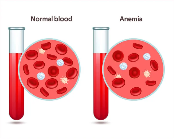 Две Пробирки Нормальной Кровью Образец Анемией Тромбоциты Лейкоциты Эритроциты Микроскопом — стоковый вектор