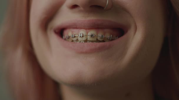 Diş Telleriyle Gülümseyen Ağız Yakından Genç Kadın Yarı Surat Gülümsemesi — Stok video