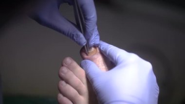 Kapatın. Podolojist cilalama ile tırnağı kazıdı. Ayak tırnağının altındaki derin temizlik. Mavi eldivenli ayak hastalıkları uzmanı parmak tırnağı parmaklarını mekanik bir aletle parlatıyor.