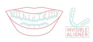 Orthodontic silicone trainer. Invisible braces aligner, retainer. Medical scheme. Outside view. Healthy smile. Mandibula. Horizontal poster. Editable vector illustration isolated on a white background clipart