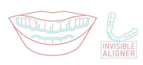 Entraîneur Orthodontique Silicone Aligneur Bretelles Invisible Retenue Régime Médical Vue — Image vectorielle