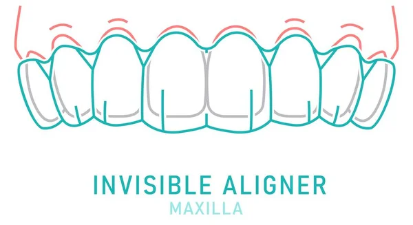 Kieferorthopädischer Silikontrainer Unsichtbare Zahnspangen Ausrichten Halten Medizinisches System Innenansicht Oberkiefer — Stockvektor