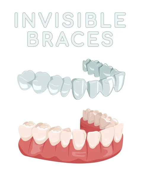Entraîneur Orthodontique Silicone Aligneur Bretelles Invisible Retenue Dessin Médical Style — Image vectorielle