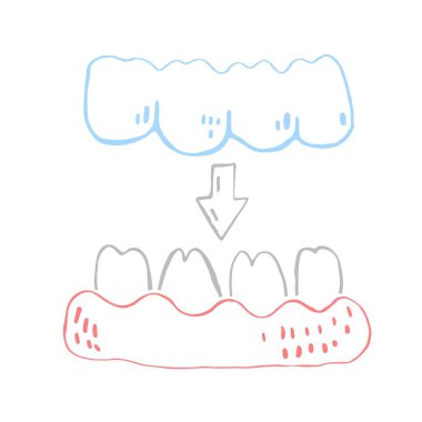Ortodontik silikon eğitmeni. Görünmez diş telleri hizalayıcı, diş teli. Elle çizilmiş tıbbi çizimler. Alt çene. Beyaz arkaplanda izole edilmiş düzenlenebilir vektör illüstrasyonu.
