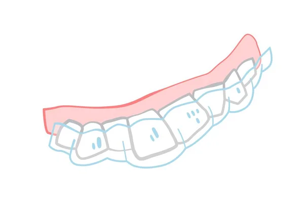 Ortodontický Silikonový Trenér Neviditelný Rovnátka Rovnátka Záloha Lékařská Kresba Ručně — Stockový vektor