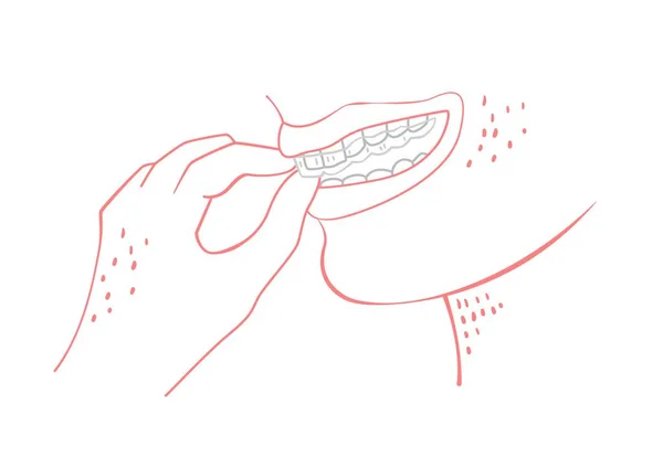 Entraîneur Orthodontique Silicone Appareils Dentaires Invisibles Concept Médical Aligneur Main — Image vectorielle