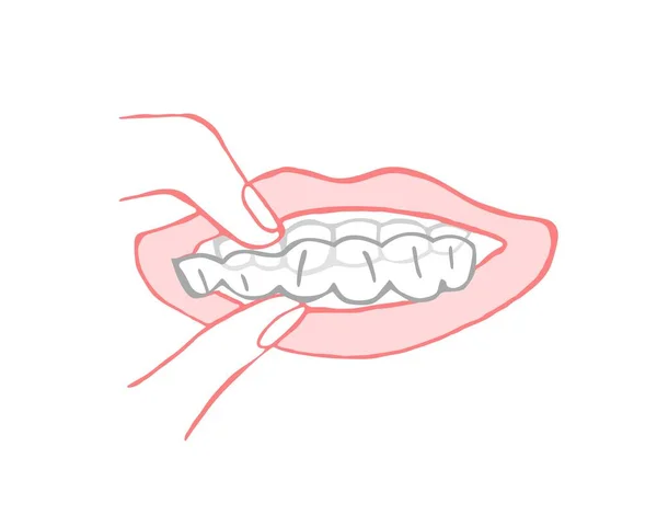 Ortodontický Silikonový Trenér Neviditelná Rovnátka Lékařský Koncept Držím Ruku Pod — Stockový vektor