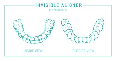 Ortodontik silikon eğitmeni. Görünmez diş telleri hizalayıcı, diş teli. Dışarısı, içerisi. Çene altında. Mandibula. Yatay tıbbi poster. Beyaz arkaplanda izole edilmiş düzenlenebilir vektör illüstrasyonu.