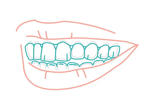 Kieferorthopädischer Silikontrainer Unsichtbare Zahnspangen Ausrichten Halten Gesundes Lächeln Unter Oberkiefer — Stockvektor