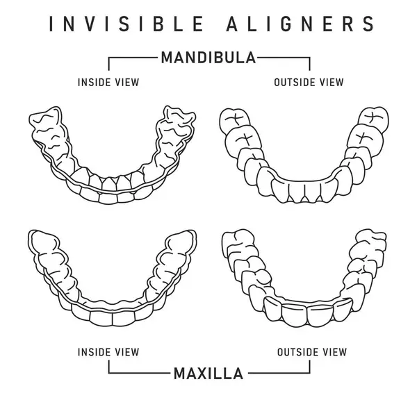 stock vector Orthodontic silicone trainer. Invisible braces aligner, retainer. Medical scheme in outline style. Outside, inside view. Upper jaw. Maxilla. Editable vector illustration isolated on a white background