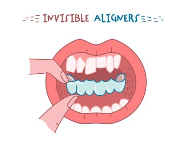 Ortodontik silikon eğitmeni. Görünmez diş teli. Tıbbi konsept. El ele tutuşmalar. Çene altında. Yatay poster. Beyaz arkaplanda izole edilmiş düzenlenebilir vektör illüstrasyonu.