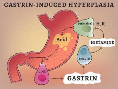 Gastrin-induced hyperplasia. Gastric acid secretion. Gastric motility stimulation. Medical infographic. Medicine, healthcare poster. Landscape background. Vector illustration. Educational print. clipart