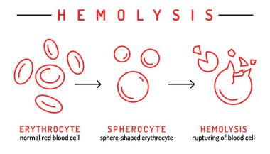 Hemolitik anemi infografisi. Vücudunda çok fazla hemolizden dolayı az sayıda kırmızı kan hücresi var. Doğrusal simgeli tıbbi şema. Düzenlenebilir felç. Beyaz arkaplanda izole edilmiş vektör illüstrasyonu