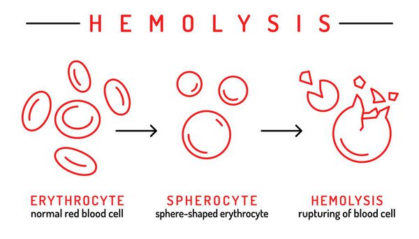 Hemolytic anemia infographic. Low number of red blood cells due to too much hemolysis in the body. Medical schema with linear icons. Editable stroke. Vector illustration isolated on a white background