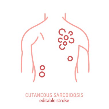 Cutaneous sarkoidoz ikonu, pictogram. Granülomatoz deri iltihabının düzenlenebilir çizimi. Tıp eğitiminde kullanılan dermatoloji sembolü, otoimmün hastalık farkındalığı ve teşhis.