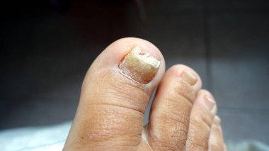 Tırnaklar ve ayak derisi iyi durumda değil, bu yüzden onlara bakılması gerekiyor..