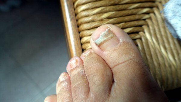 The nails and the skin of the foot are not in good condition so they need to be taken care of.