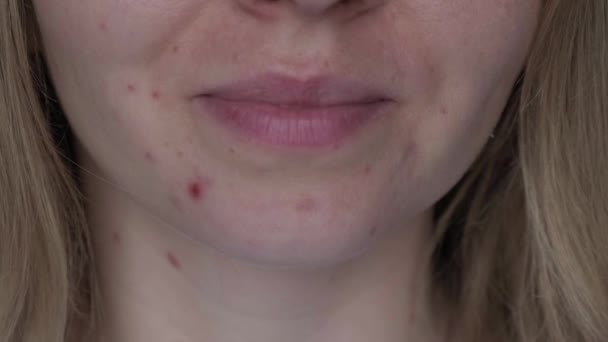 难以辨认的女人微笑着 脸上露出粉刺 接受真正的皮肤不完美女性的近视痤疮面对皮疹 疤痕和对化妆品过敏的斑点 皮肤护理和 — 图库视频影像