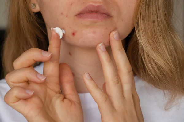 Oigenkännlig Kvinna Tillämpar Makeup Kräm Serum Botemedel Mot Akne Ansiktet — Stockfoto