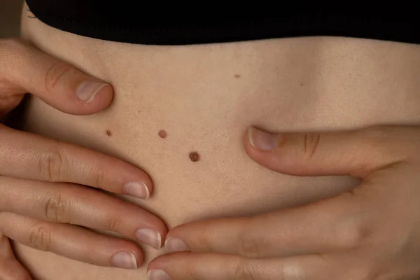 Unrecognizable woman showing her Birthmarks on skin Close up detail of the bare skin Sun Exposure effect on skin, Health Effects of UV Radiation Woman with birthmarks Pigmentation and lot of