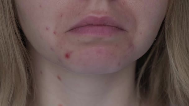 Felismerhetetlen Feldúlt Mosolygás Mutatja Pattanások Arcán Elfogadás Valódi Bőr Tökéletlenség — Stock videók