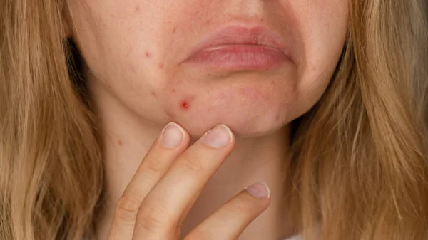 Unrecognizable Woman Upset Smiling Showing Her Acne Face Acceptance Real — Stock Photo, Image