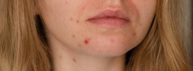 Unrecognizable woman showing her acne on face. Close-up acne on woman's face with rash skin ,scar and spot that allergic to cosmetics. Banner Problem skincare and health concept. Wrinkles, melasma, dark spots, freckles, dry skin, acne blackheads on f