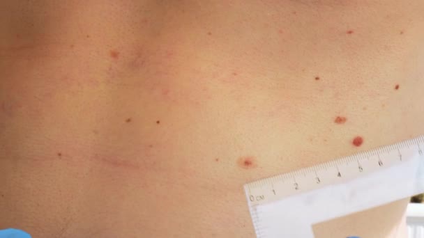 Dermatologe Überprüft Männliche Muttermale Mit Lineal Arzt Untersucht Länge Und — Stockvideo