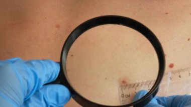 Köstebek dermoskopisi, melanom önleyici. Cildiyeciler klinikteki doğum lekelerini büyüteçle inceliyor. İyi huylu köstebekleri kontrol ediyorum. Deri anormallikleri bakım konsepti.