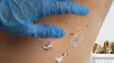 Dermatolog erkek doğum lekelerine cilt kremi sürmüş. İyi huylu köstebekleri kontrol ediyorum. Cilt kanseri prosedürünün tanıtımı. Doktor deri etiketlerini kontrol ediyor.