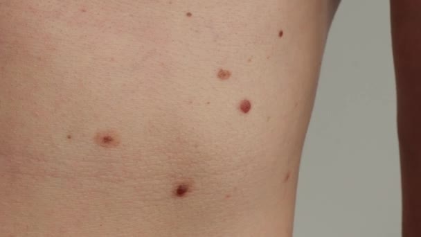 Unrecognizable Man Showing His Birthmarks Skin Close Detail Bare Skin — Stock Video