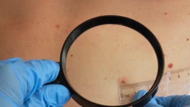 Mullvaddermoskopi Förebyggande Melanom Dermatolog Undersöker Patienter Födelsemärke Med Förstoringsglas Kliniken — Stockvideo