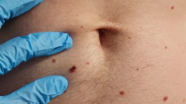 Arzt Medizinischen Handschuhen Untersucht Mann Hautmaulwurf Dermatologe Überprüft Männliche Muttermale — Stockvideo