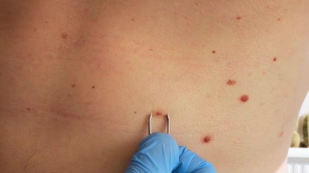 Arzt Medizinischen Handschuhen Untersucht Mann Hautmaulwurf Dermatologe Überprüft Männliche Muttermale — Stockvideo