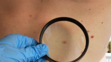 Köstebek dermoskopisi, melanom önleyici. Cildiyeciler klinikteki doğum lekelerini büyüteçle inceliyor. İyi huylu köstebekleri kontrol ediyorum. Deri anormallikleri bakım konsepti.