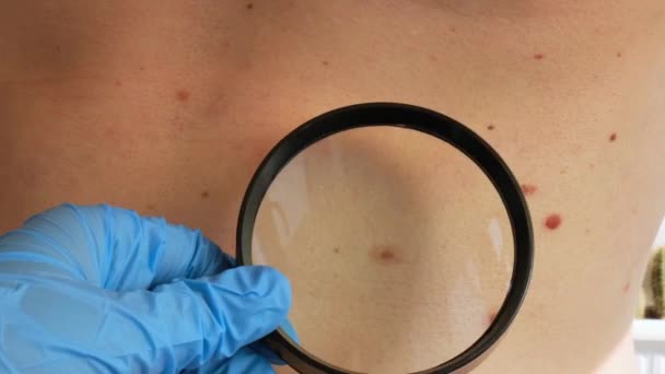 Mole Dermoscopy Preventive Melanoma Dermatologist Examining Patients Birthmark Magnifying Glass — Stock Video