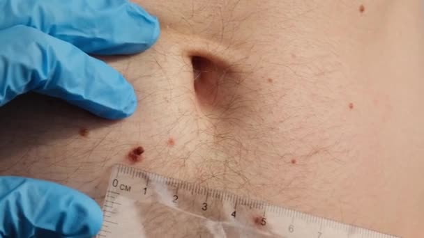 男性の出生マークを調べる デルマトロジスト 人の皮膚の顔料の良性の分子の長さそして幅を調べる医者 — ストック動画