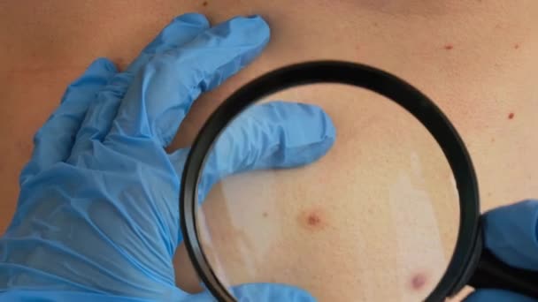 Dermatoscopia Lunar Preventiva Del Melanoma Dermatólogo Examinando Pacientes Con Marca — Vídeos de Stock