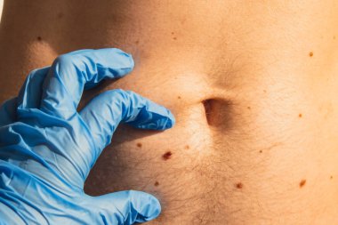 Cildiyeci erkek doğum lekelerini kontrol ediyor. Tıbbi eldivenli doktor deri benini inceliyor. Kişisel bakım kanser prosedürünü engelliyor. Koruma tedavisi. Kusurlu cilt pozitifliği