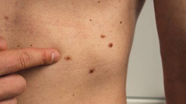 Erkek el, deri parçasında doğum lekeleri gösteriyor. Çıplak derinin detaylarını kapat. Ultraviyole ışınımın sağlık etkileri. Doğum lekeleri olan bir adam. Pigmentasyon ve bir sürü doğum lekesi.