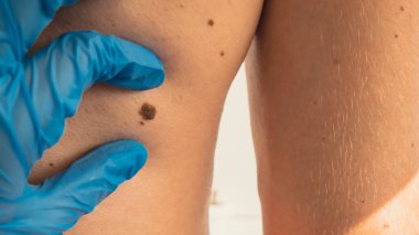 Tıbbi eldivenli doktor deri benini inceliyor. Cildiyeci erkek doğum lekelerini kontrol ediyor. Kişisel bakım kanser prosedürünü engelliyor. Koruma tedavisi. Kusurlu cilt pozitifliği