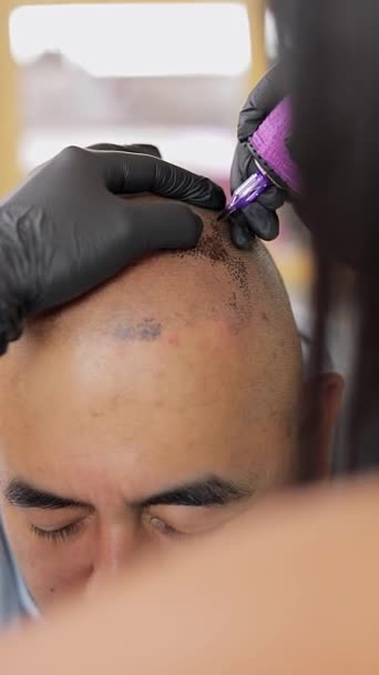 Homme Recevant Traitement Micropigmentation Capillaire Les Cheveux Sont Tatoués Sur — Video