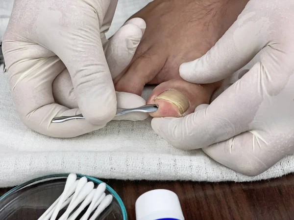 医者の診察室で医者の足の爪の検査 — ストック写真