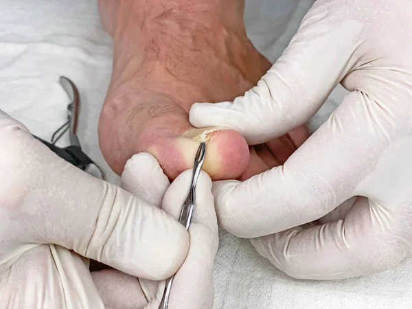 Επιθεώρηση Των Νυχιών Στο Πόδι Από Γιατρό Στο Γραφείο Του — Φωτογραφία Αρχείου
