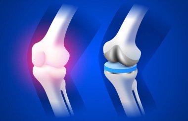 Diz implantı, bacak röntgeni, üç boyutlu görselleştirme. Vektör